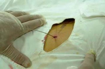 手術(shù)切口.jpg 手術(shù)切口.jpg