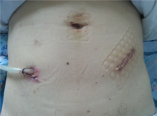 腹腔鏡乙狀結腸癌根治術(shù)切口.jpg